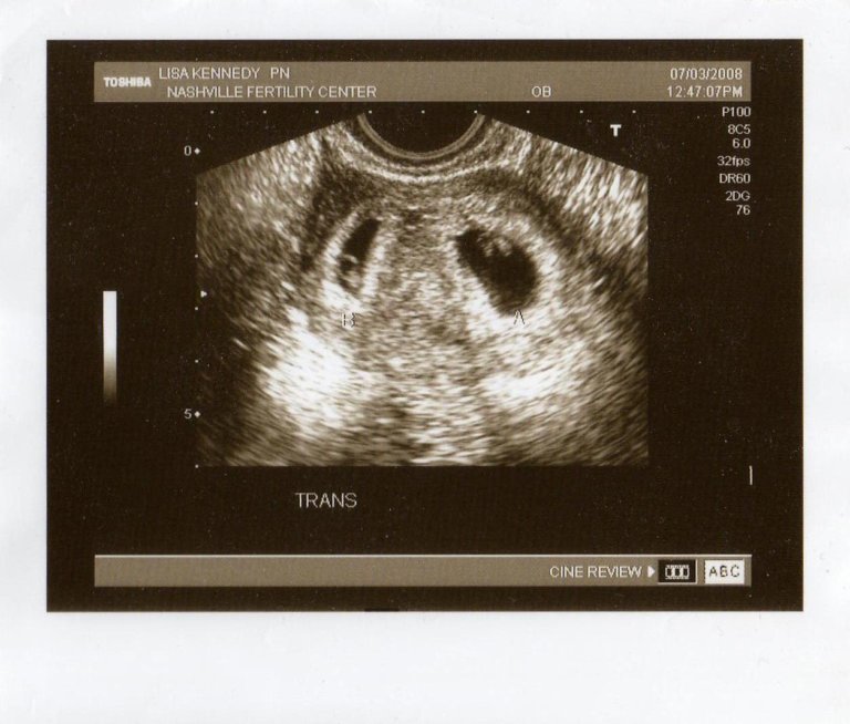 twins 6 wks